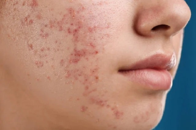  une femme ayant beaucoup d'acné sur son visage