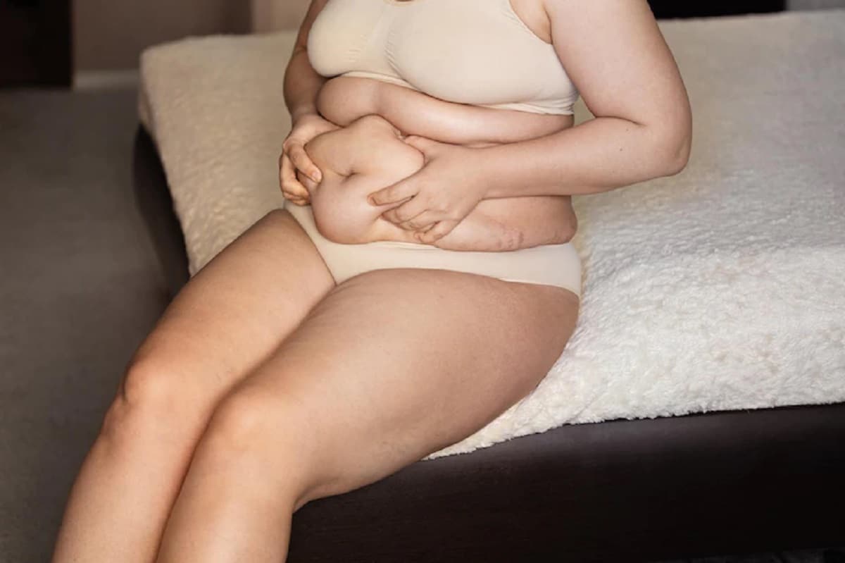 une femme ayant graisse sous cutanee.jpg