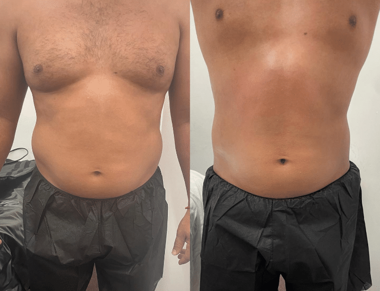 homme avant et après cryolipolyse