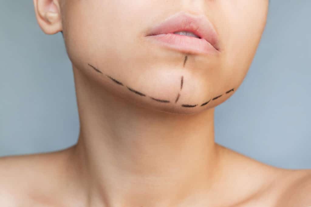 Tracé avant chirurgie esthétique correctrice pour le double menton