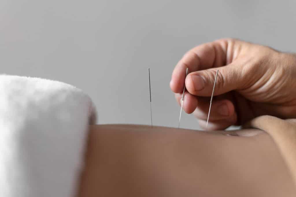 l'acupuncture