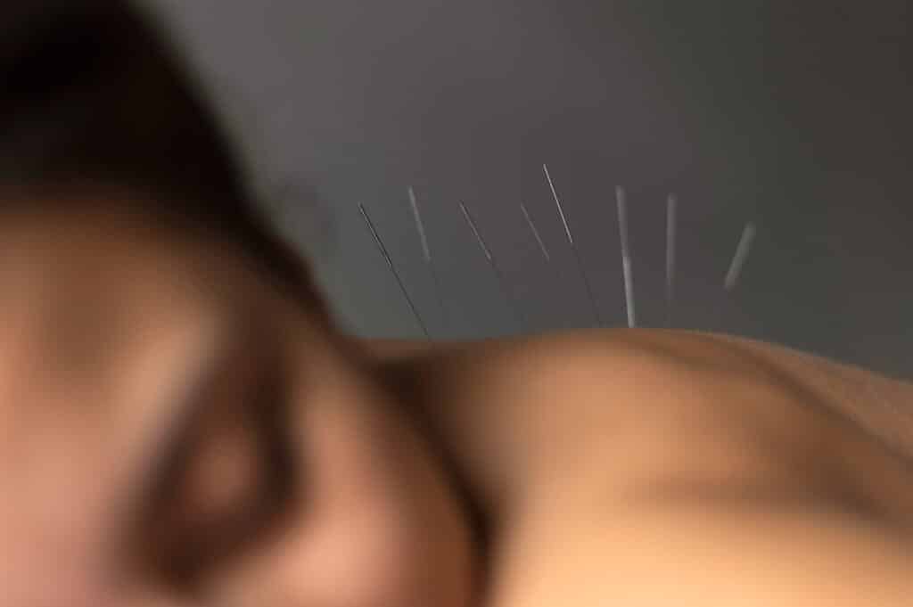 une femme veut maigrir avec l'acupuncture