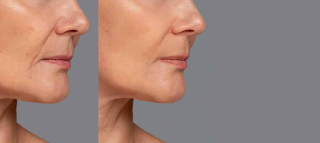 avant après jet peel