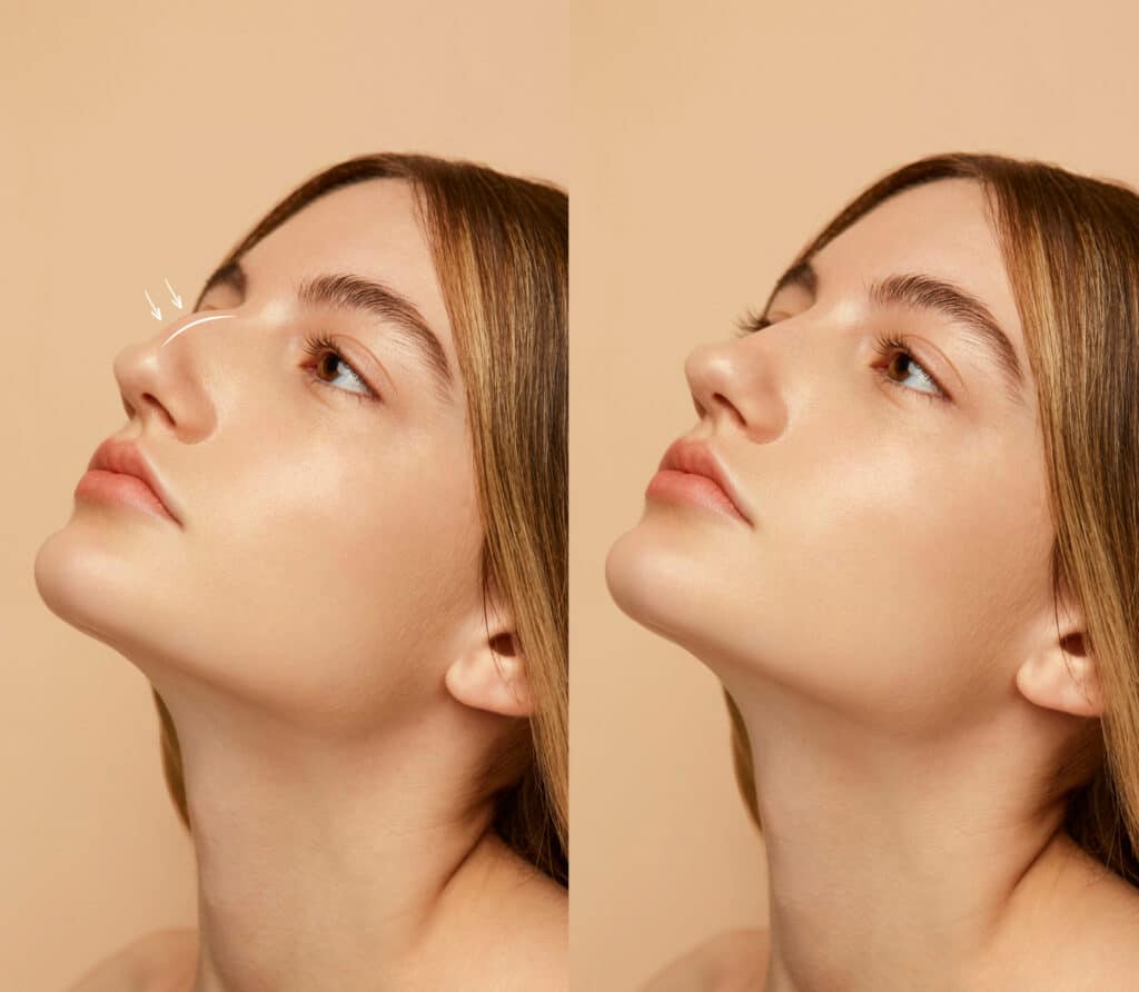 avant apres rhinoplastie