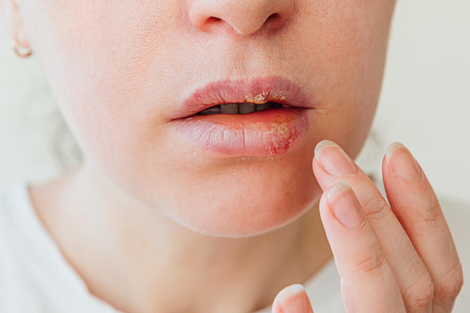 faire partir lherpes