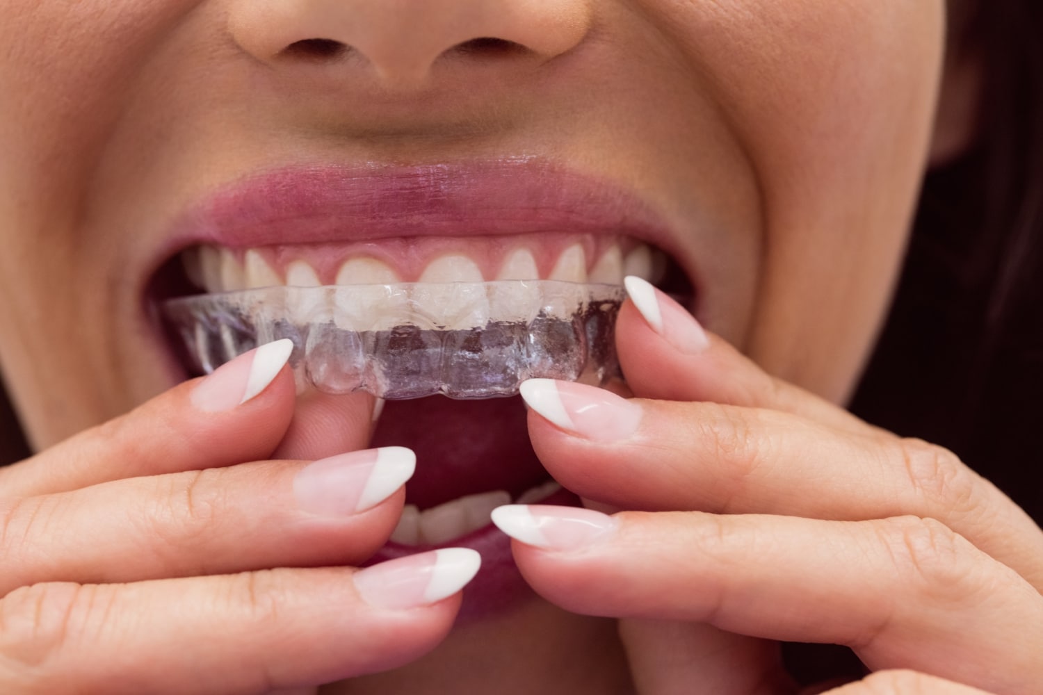66841aa591ff3 orthodontiste et invisalign